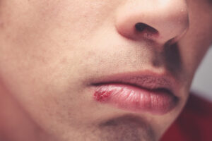 fever blister cold sore